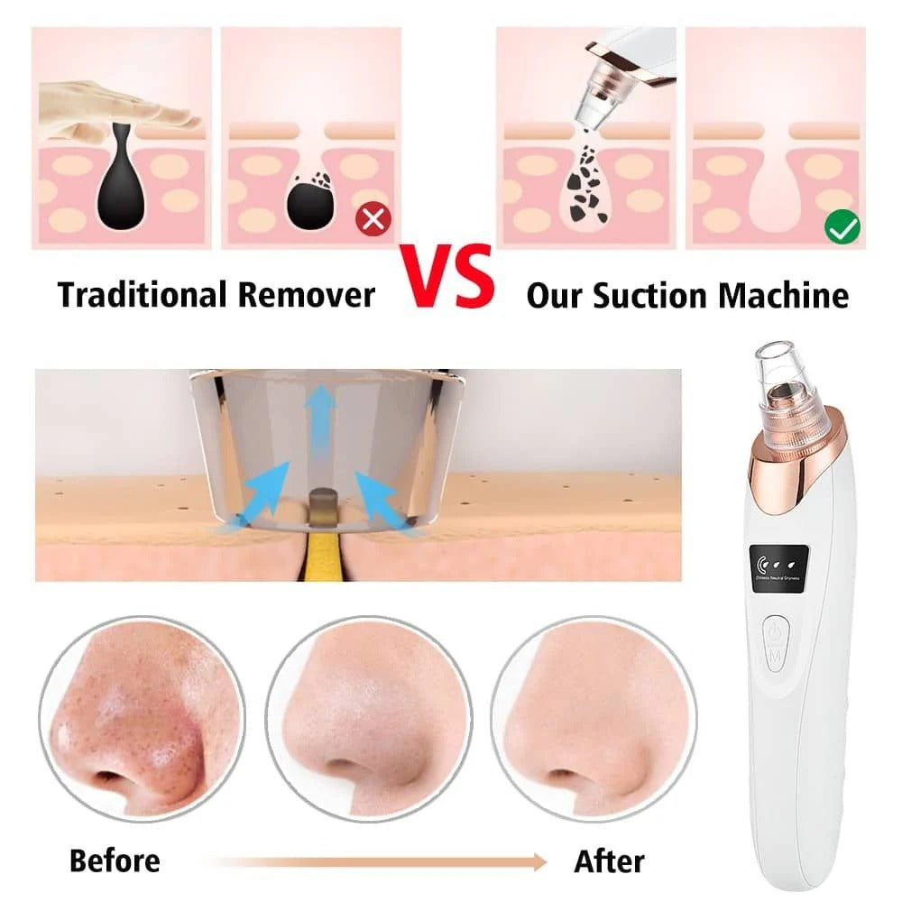 Digital Blackhead Remover Vacuum – Electric Pore Cleaner & Acne Remover Facial Tool